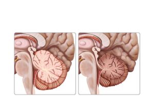 hipoplasia cerebelar y ataxias