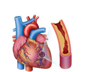 infarto agudo de miocardio