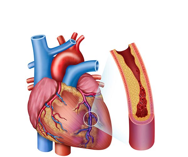 infarto agudo de miocardio infarto agudo de miocardio