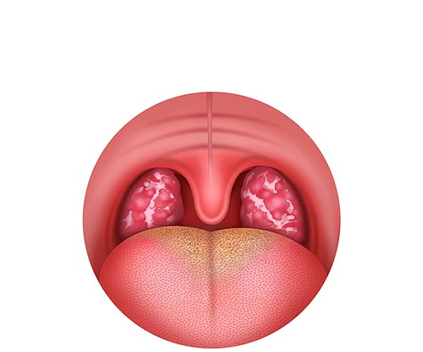 inflamacion de amigdalas inflamacion de amigdalas
