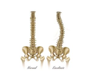 la escoliosis vertebral