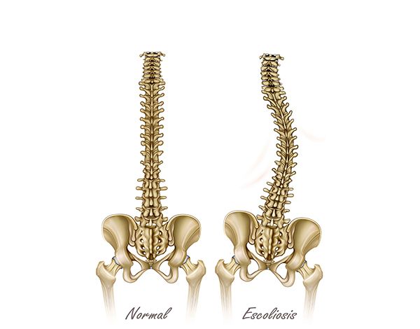 la escoliosis vertebral la escoliosis vertebral