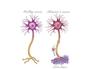 la neurona en alzheimer