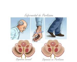 la dopamina en parkinson