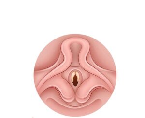 laringomalacia