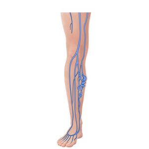 legs with varicose veins