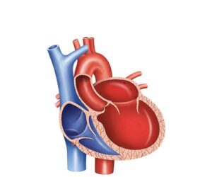 miocardiopatía dilatada