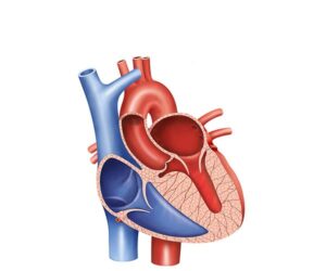 miocardiopatía hipertrófica