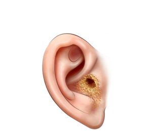 otitis externa del oído