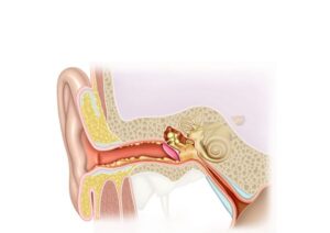 otitis media with effusion