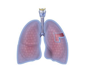 pleura pulmonar