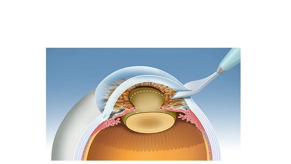 process 1 cataract surgery process 1 cataract surgery