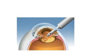 process 2 cataract surgery