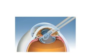 process 3 cataract surgery