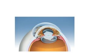 process 4 cataract surgery