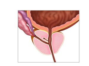 prostata