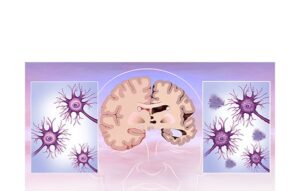 reducción cerebral en alzheimer