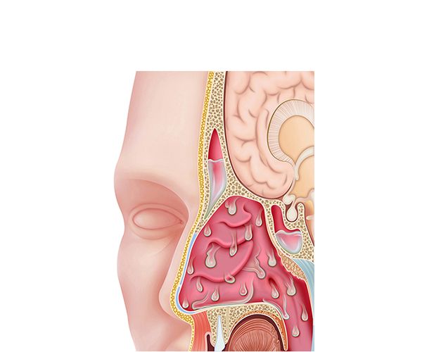 rinitis y sinusitis rinitis y sinusitis