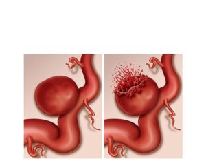 ruptura de aneurisma