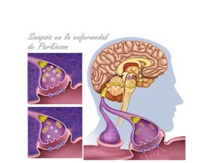 sinapsis en la enfermedad de parkinson