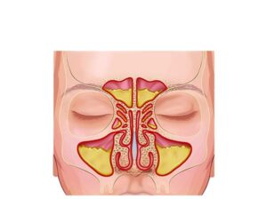 sinusitis crónica