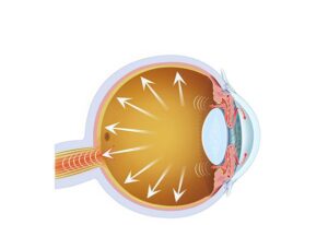 the eye and glaucoma