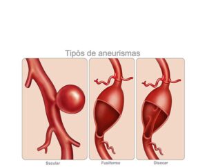 tipos de aneurismas