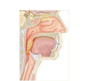 tumor de orofaringe