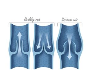 varicose vein valve