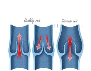 varicose vein valves