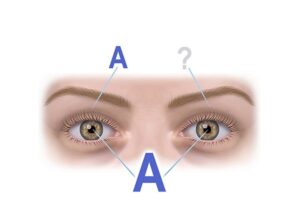 visión amblyopia