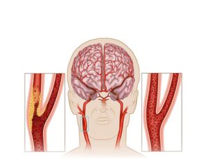 artereocleorosis en carotida