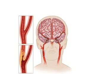 carotida con artereocleorosis