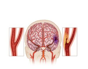 carotida y artereocleorosis