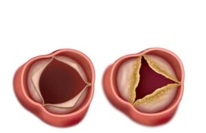 estenosis válvular aórtica abierta