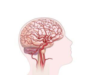 cerebral aneurysms