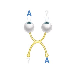 visual amblyopia