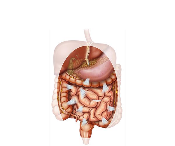 adhesion abdominal adhesion abdominal