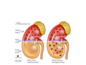 albuminuria
