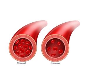 anemia