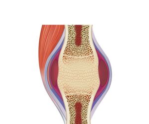 anquilosis articular