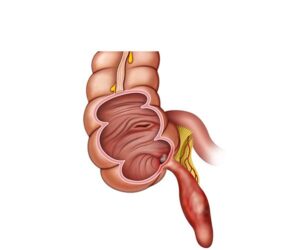 apendicitis