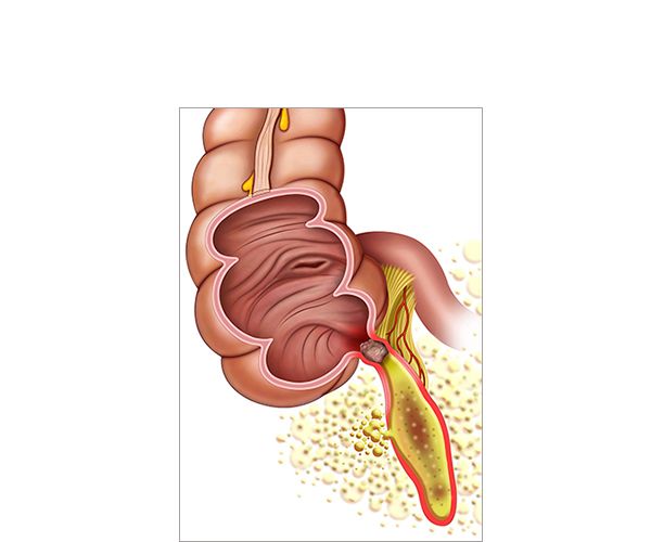 ruptura de apendicitis ruptura de apendicitis