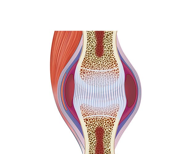 artritis con tejido conectivo fibroso artritis con tejido conectivo fibroso