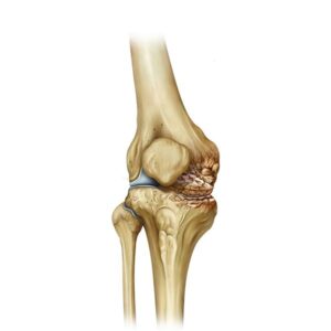 artrosis de rodilla