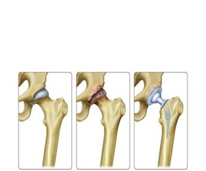 artrosis de cadera y femur