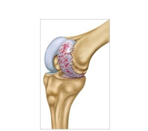 artrosis de la rodilla