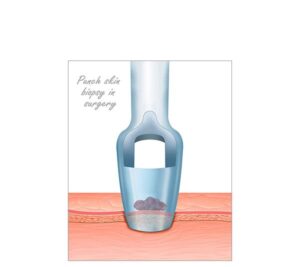 biopsia cutánea por punch