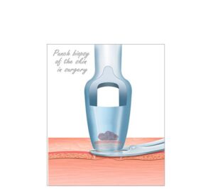 biopsia de piel con punch