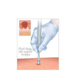 biopsia de piel por punch
